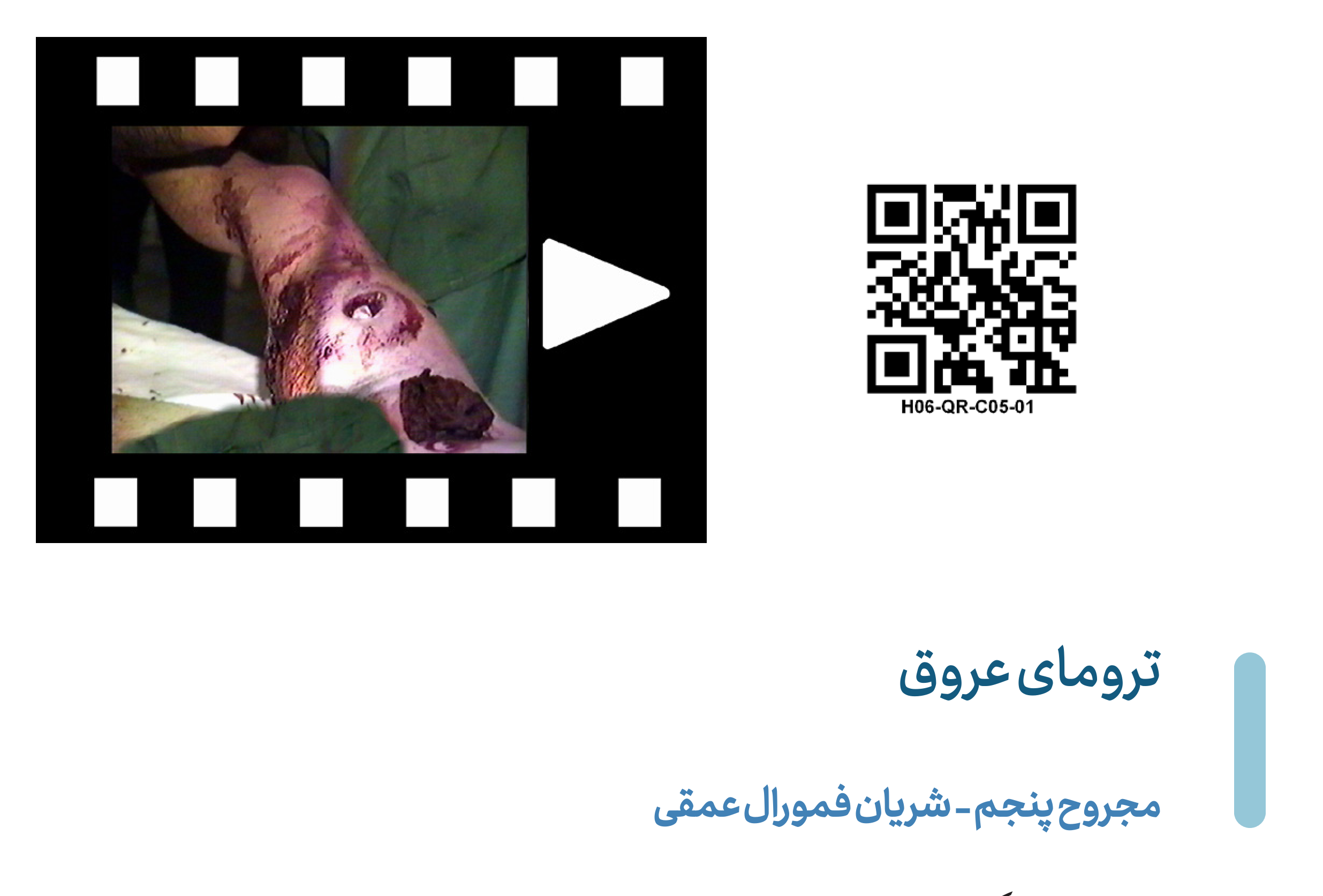Deep_Femoral-V05