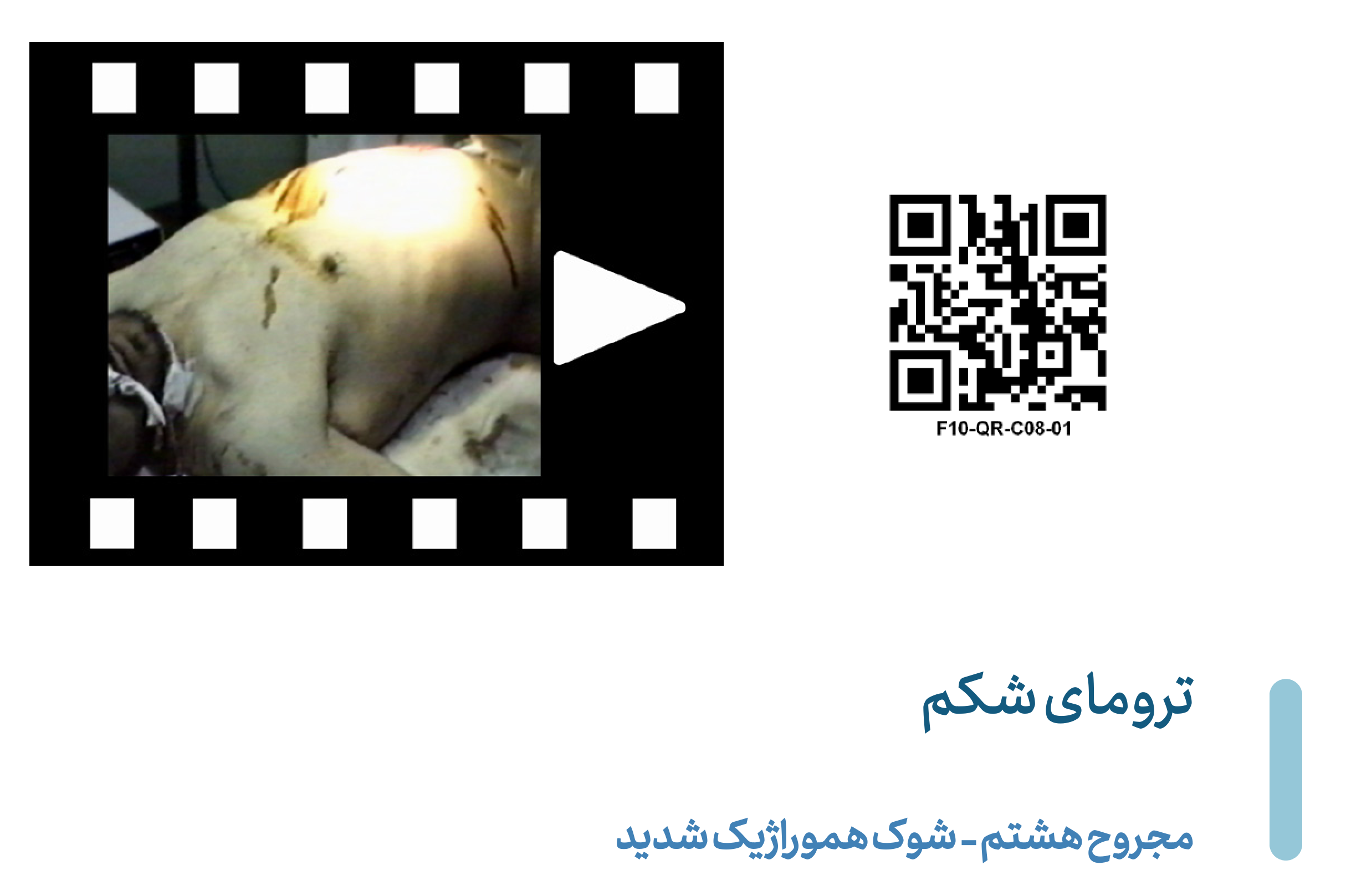 Severe Hemorrhagic shock 