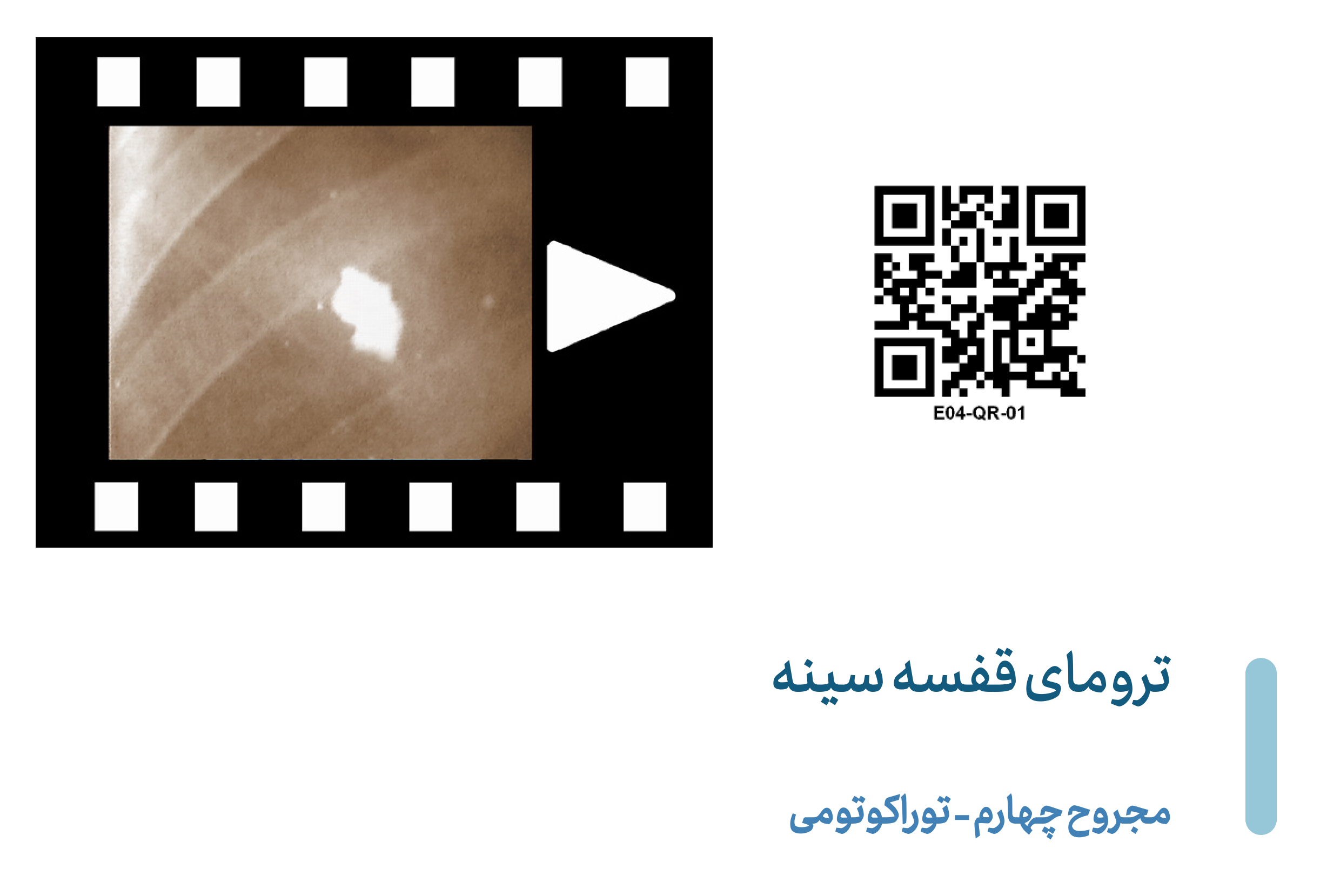 Thoracotomy 