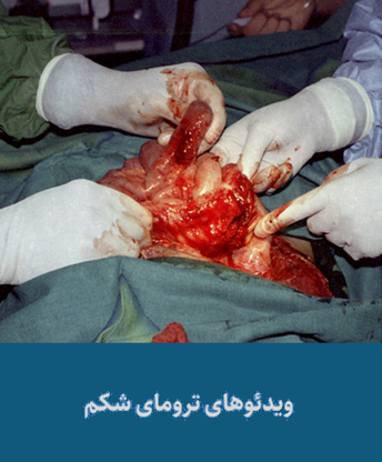 ترومای شکم